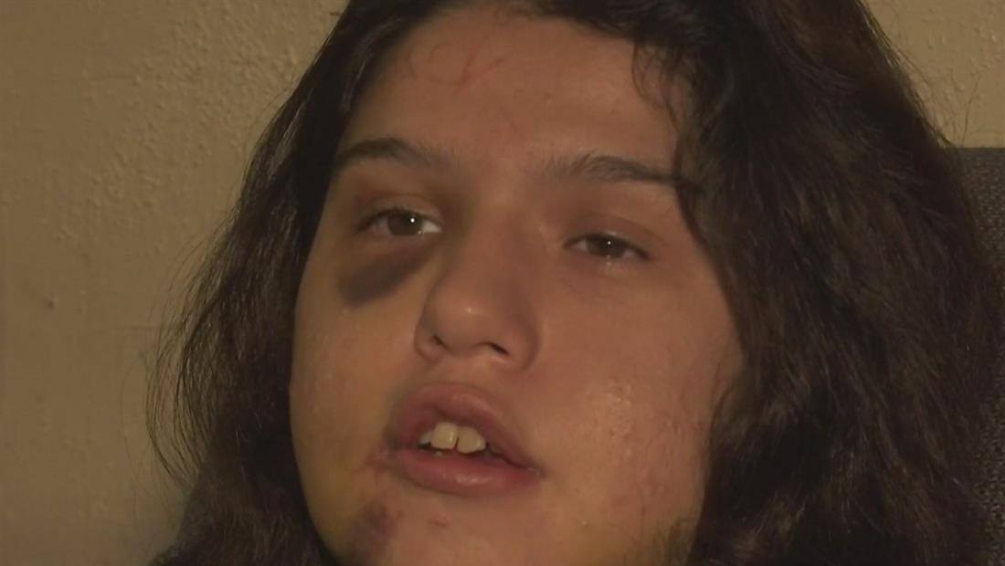 Hombre talla su nombre en la frente de su novia con un cuchillo Hombre talla su nombre en la frente de su novia con un cuchillo