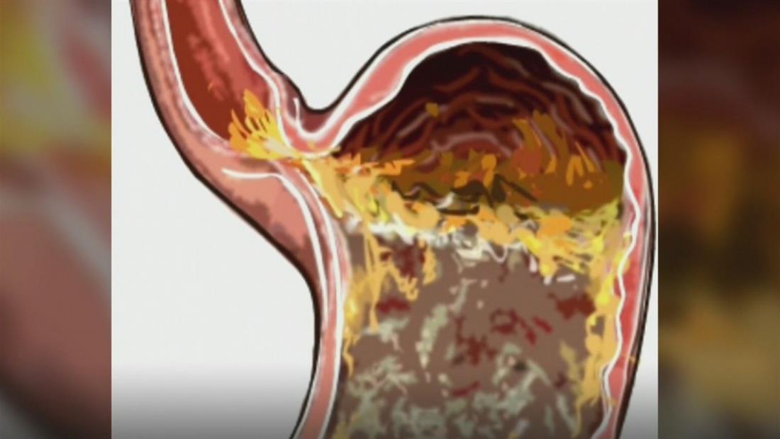 Alertan sobre los riesgos de la acidez estomacal y su posible vínculo con el cáncer Alertan sobre los riesgos de la acidez estomacal y su posible vínculo con el cáncer
