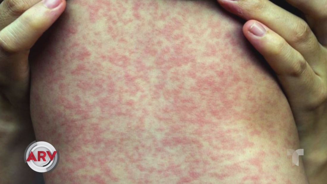 Alerta por brote de sarampión en Los Ángeles Alerta por brote de sarampión en Los Ángeles